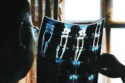 男子因听闻30万手术费自锯病腿 专家称仅需数万